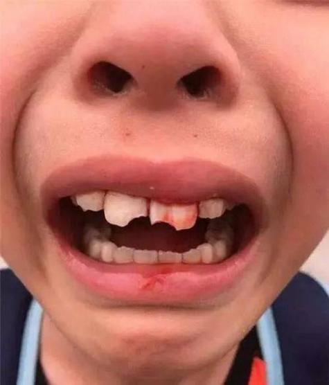 惊恐:梦见自己牙齿掉了流血了