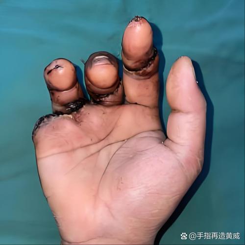 手与财富关联诈骗_噩梦成真手被砍伤预兆_梦见被诈骗