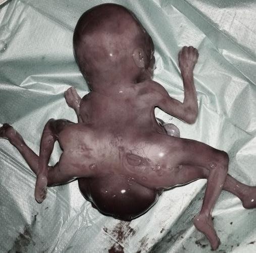 男人梦见生畸形胎儿_梦见胎儿_梦见两个畸形婴儿